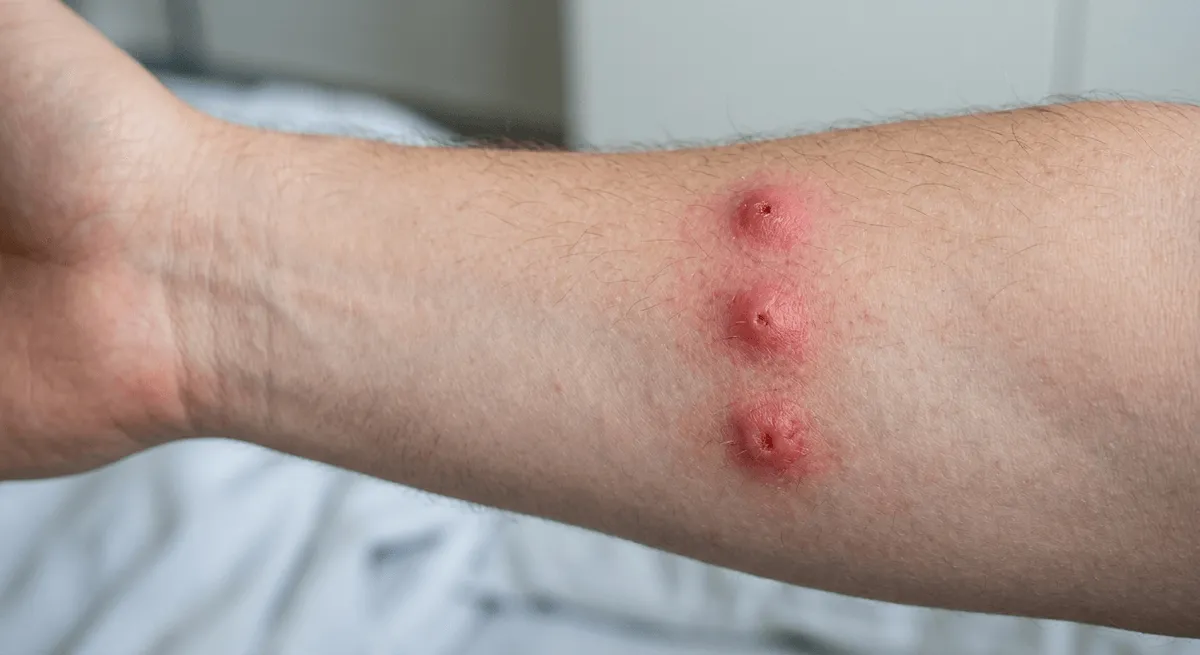 Réaction cutanée typique aux piqûres de punaises de lit